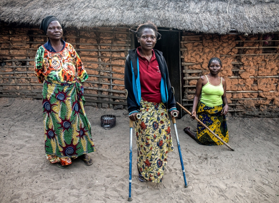 African women affected by Konzo disease